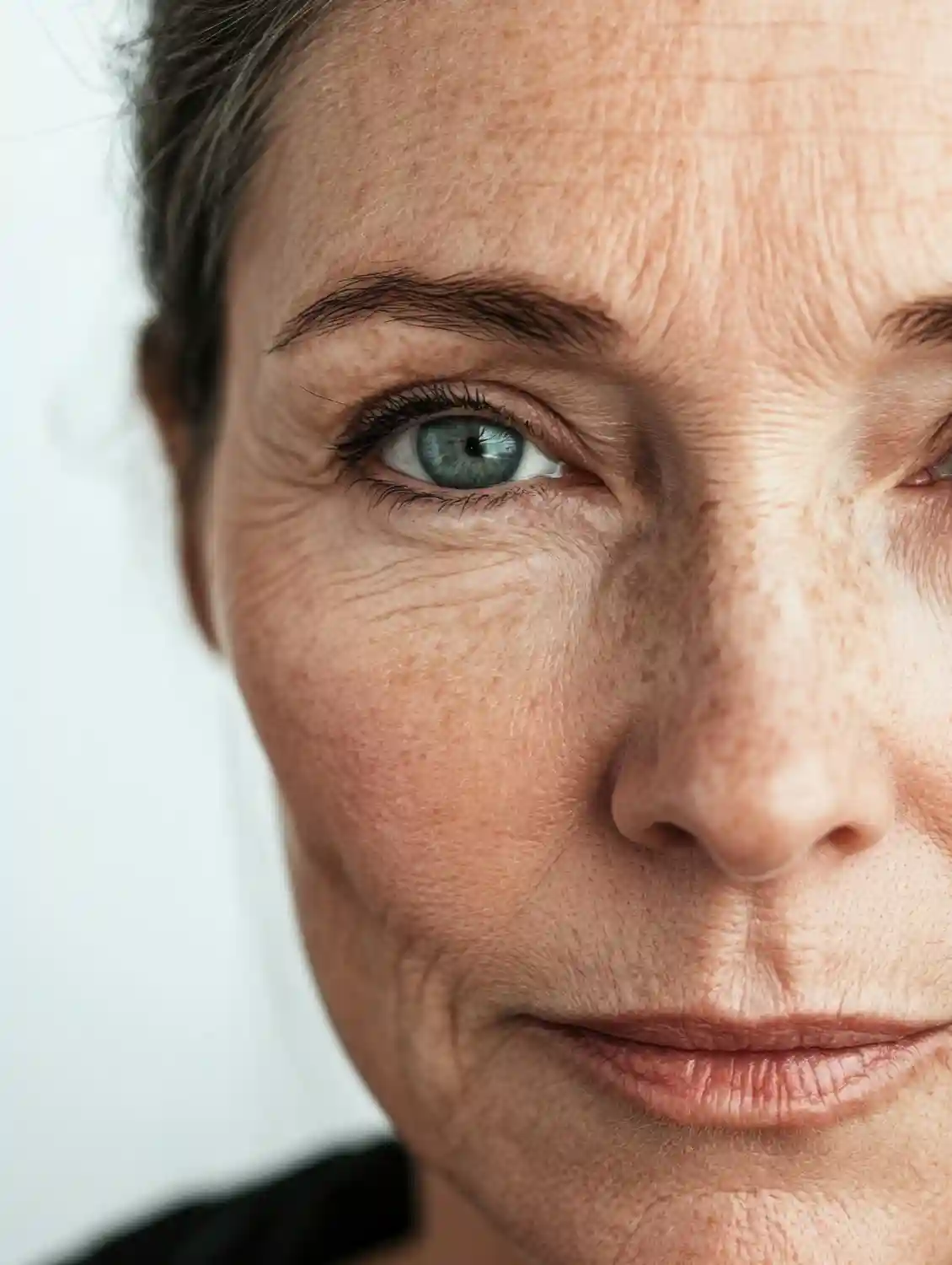 Botox treatment for crow’s feet in Hobart at Heart Aesthetics to reduce wrinkles around the eyes.