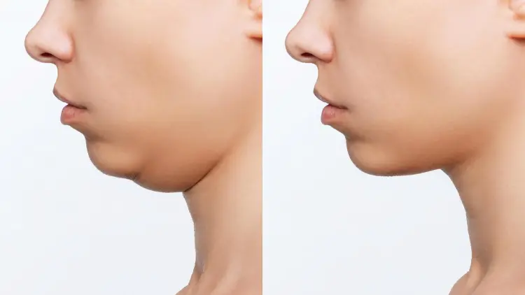 Patient consultation for double chin treatment using fat dissolving injections in Hobart