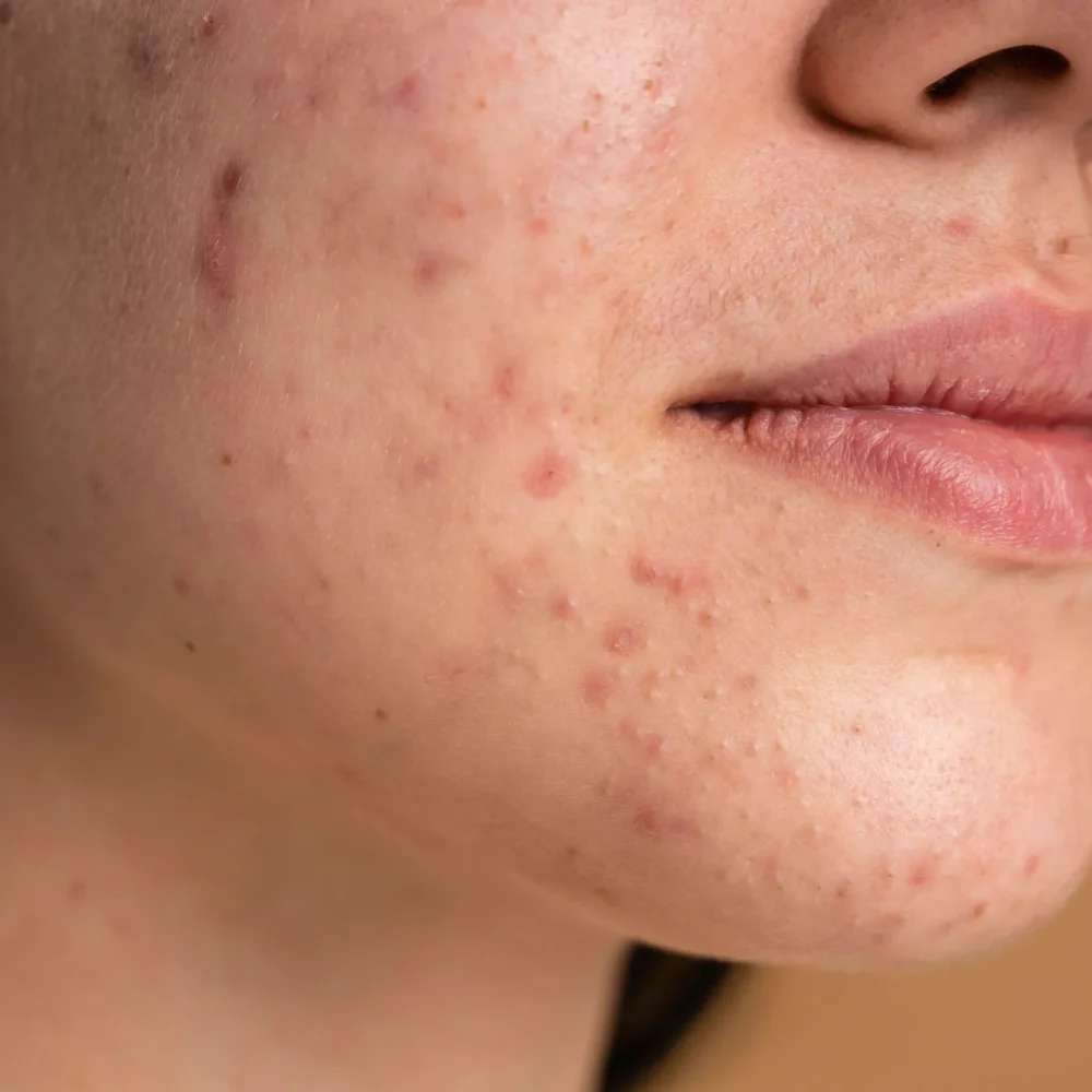 Acne scar treatment in Hobart at Heart Aesthetics for skin rejuvenation