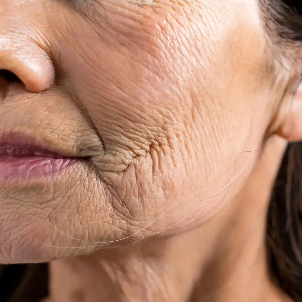 Aging skin treatment and wrinkle reduction at Heart Aesthetics Hobart