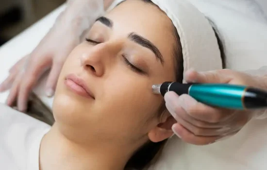 Micro-needling for fine lines and wrinkles at Heart Aesthetics Hobart