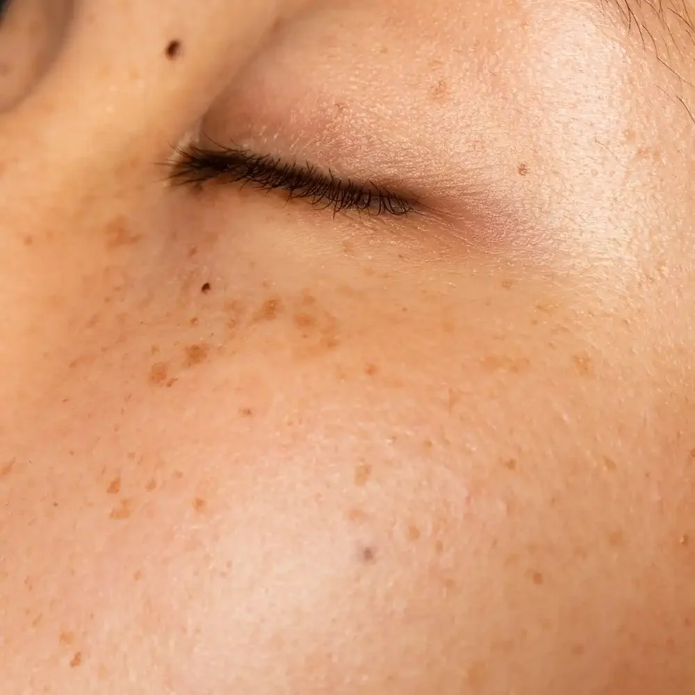 Pigmentation treatment for sun damage and sun spots in Hobart using skin needling at Heart Aesthetics.